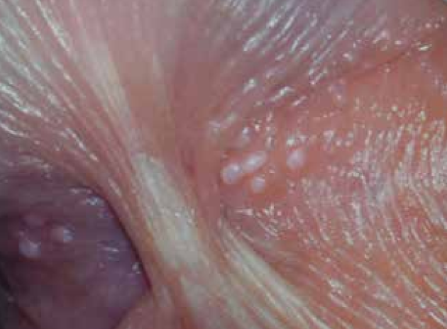 包皮小帯(裏スジ)の左右に見られる包皮腺