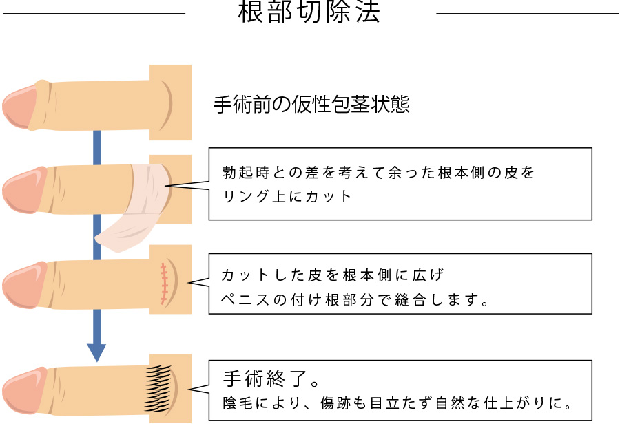 根部切除法