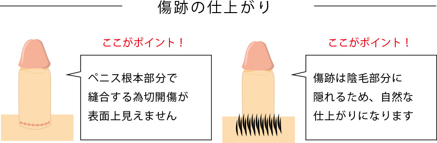 根部切除法