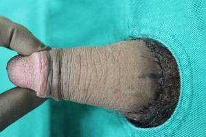 根部切除