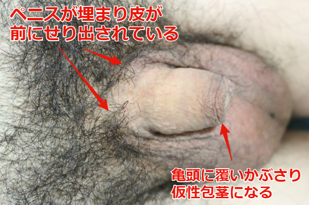 埋没包茎の状態を示すペニスのイラスト