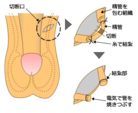 パイプカット(精管切除結紮)手術の模式図