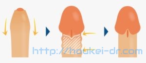 ハイパーVカット法