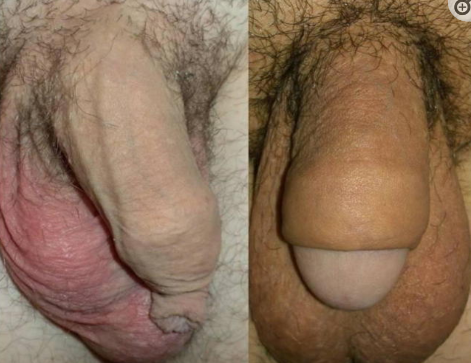 過剰包皮