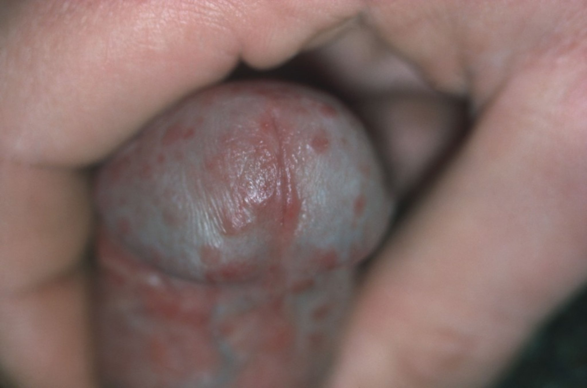 陰茎癌(上皮内がん)penile cancer