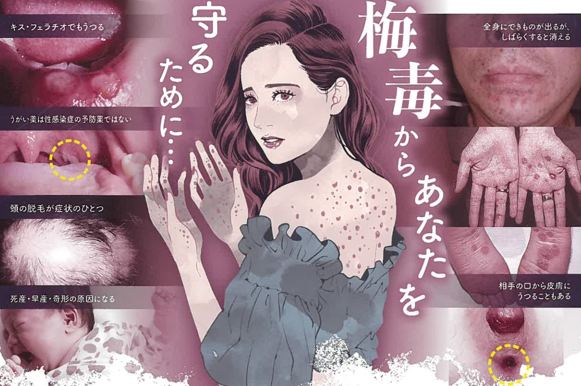 梅毒の初期症状に注意！感染経路と検査・治療の詳細解説