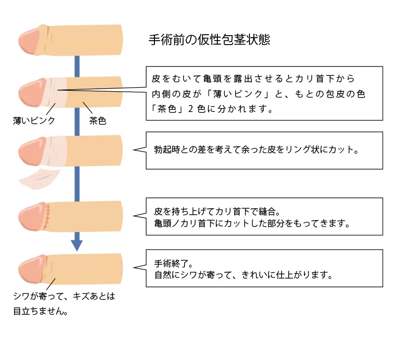 亀頭直下埋没法の術式イメージ図