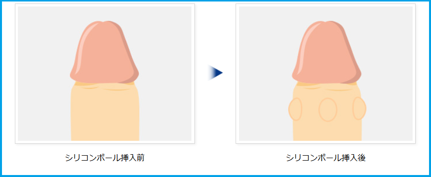 シリコンボール手術前後