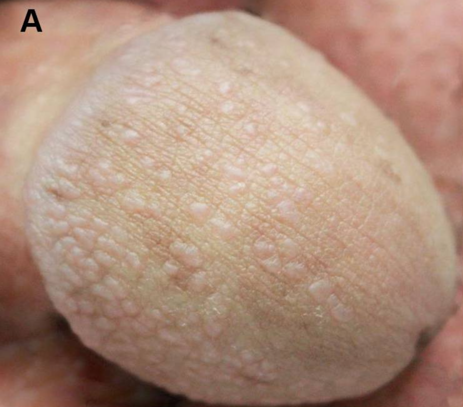 亀頭・陰茎のブツブツ：光沢苔癬は性病ではない