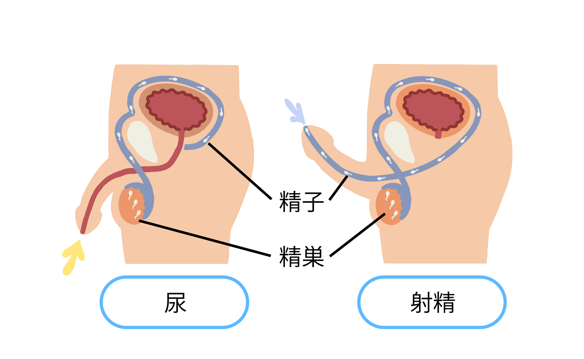 パイプカットの4つのデメリットと手術前の重要ポイント