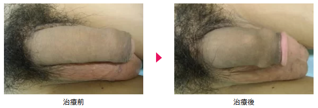 シリコンボール治療前後の写真