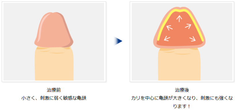 亀頭増大リパスGによる早漏治療の説明図
