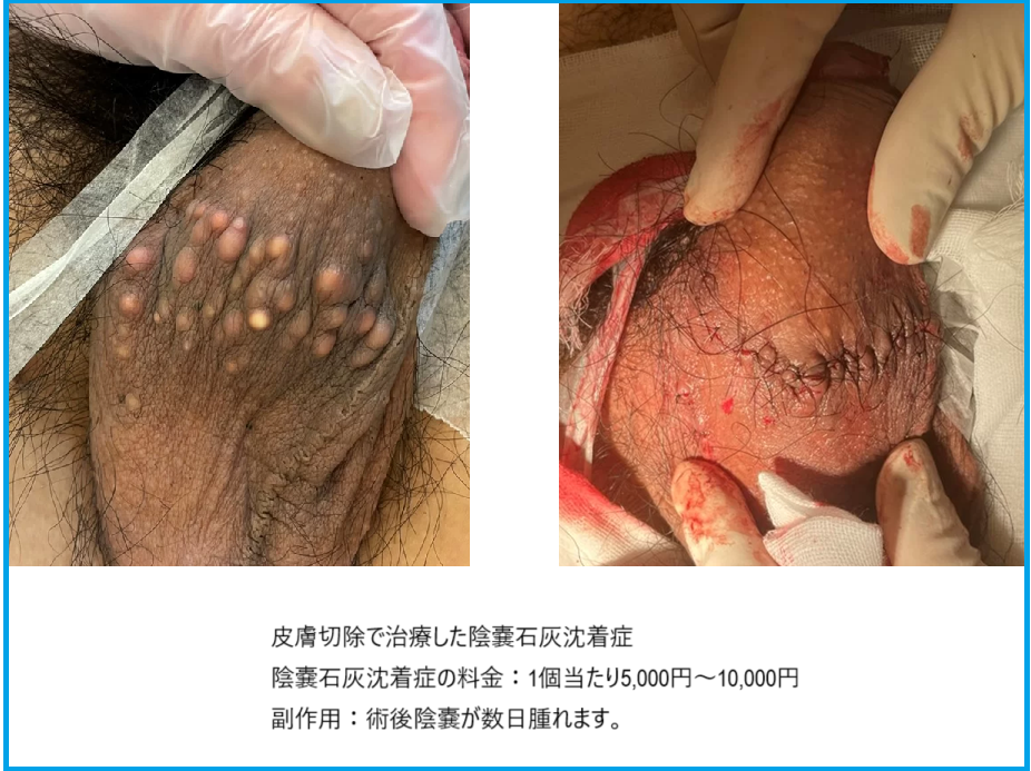 皮膚切除治療の陰嚢石灰沈着症