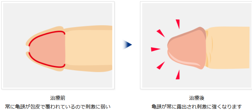 包茎手術による早漏改善の説明図