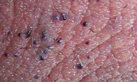陰嚢被角血管腫とは?玉袋にできる赤い血豆とブツブツの正体