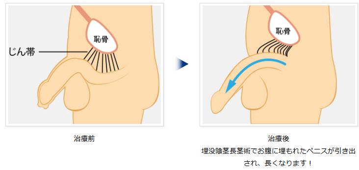 埋没陰茎長茎手術の模式図