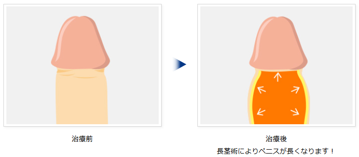 リパス注入による長茎効果の模式図