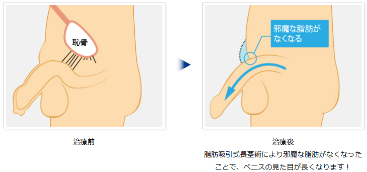 脂肪吸引式長茎手術の模式図