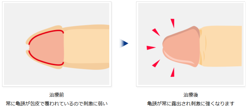 包茎手術のビフォーアフターイメージ