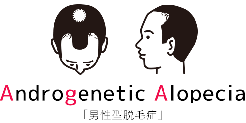 AGA治療は薬以外でも可能？飲み薬以外で治す最新の薄毛治療法