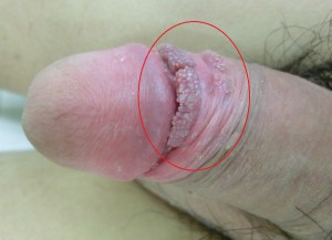 “ペニス（ちんこ）のブツブツtitle="コンジローマ