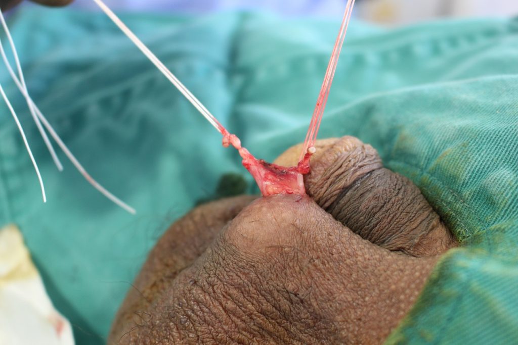 精管切除術は保険適用されますか?