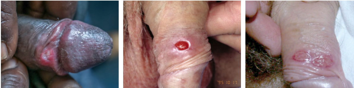 梅毒の陰茎潰瘍