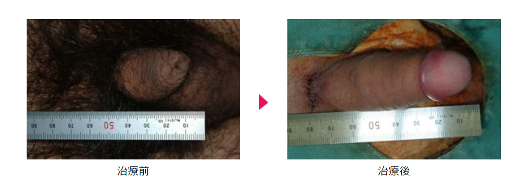 ↑筆者が行うバック筋膜を用いた長茎術の手術前後写真②