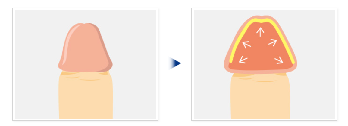 亀頭増大のイメージ