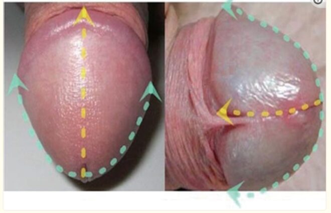 亀頭増大増大の測定方法