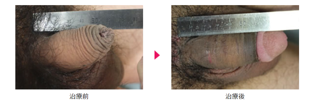 ↑筆者が行うバック筋膜を用いた長茎術の手術前後写真①