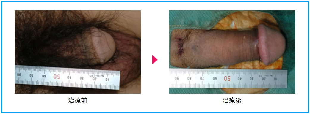 長茎術ビフォーアフター