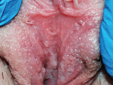 女性の真珠様小丘疹｜正常な見た目と特徴