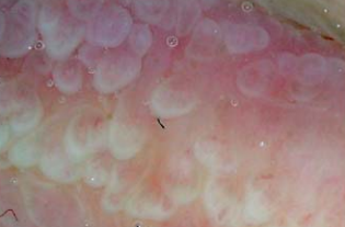 真珠様陰茎丘疹の詳細写真｜小さな白いブツブツの拡大