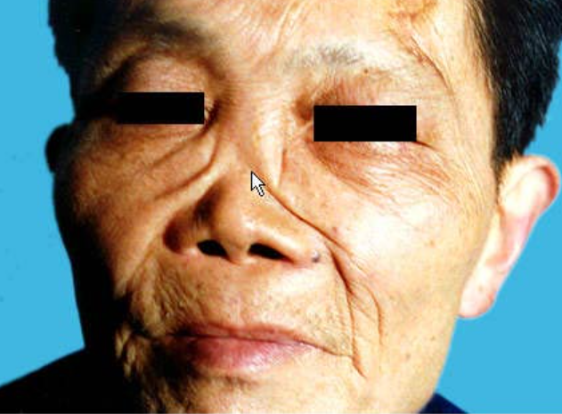 梅毒による鞍鼻