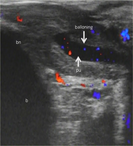 図3：男の潮吹き