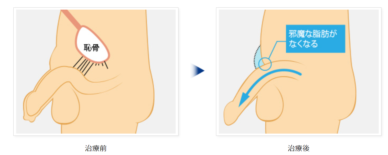 脂肪吸引式長茎術