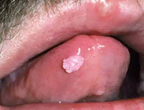舌の先端にできた尖圭コンジローマ