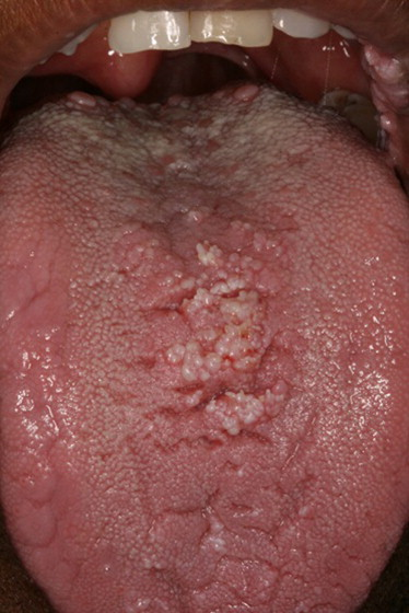 口腔内の尖圭コンジローマ(HIV患者）
