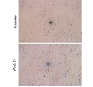 外用薬の発毛効果