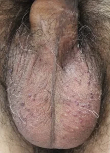 陰嚢被角血管腫