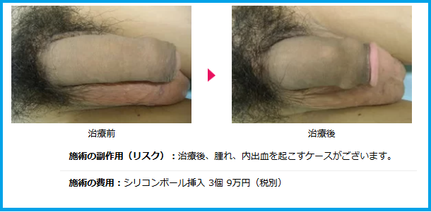 シリコンボール挿入