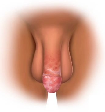 カンジダ亀頭包皮炎