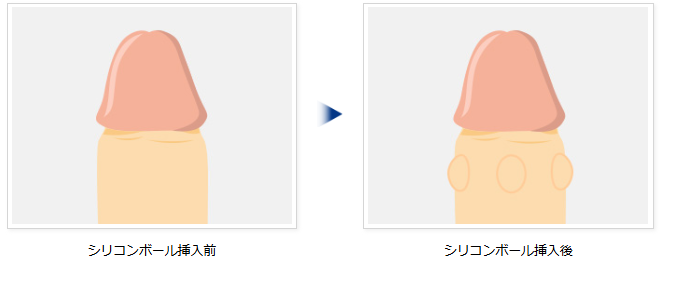 シリコンボール