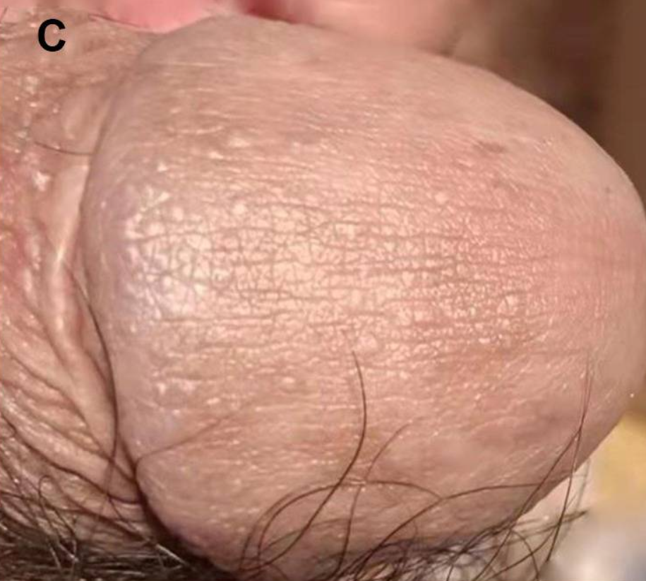 亀頭の光沢苔癬1年後