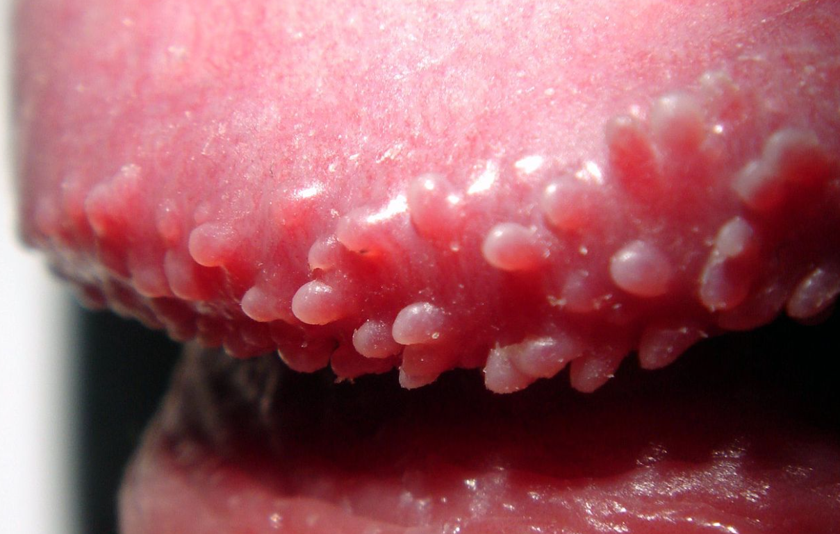 真珠様小丘疹の写真