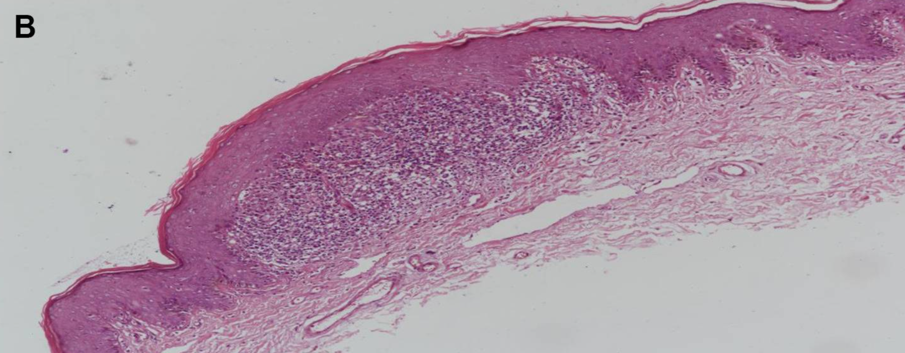 光沢苔癬の病理組織像