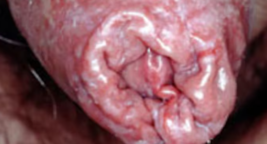 カンジダ亀頭包皮炎の包皮