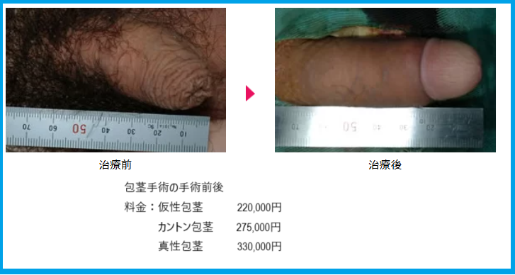 包茎手術の料金