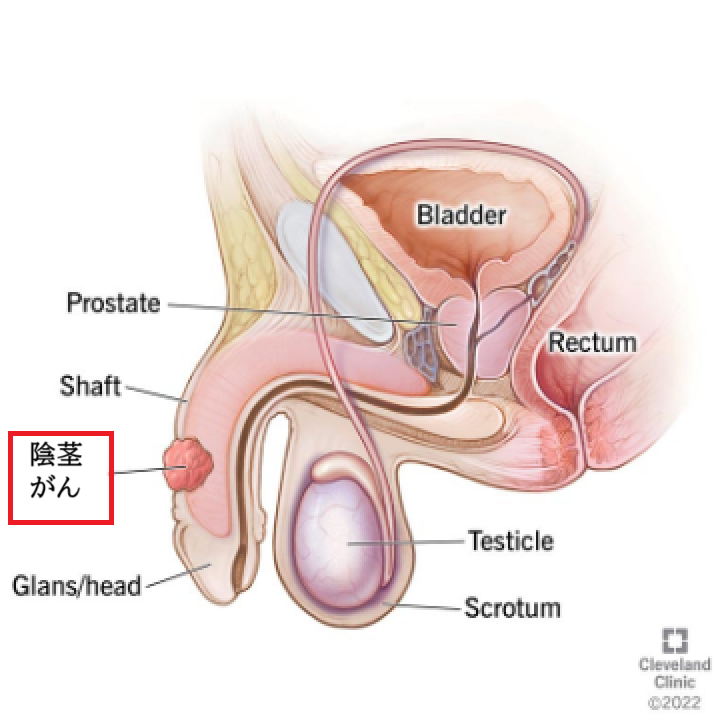 陰茎がん